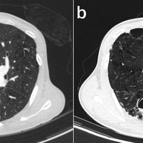 Comparison Of Preoperative And Postoperative Computed Tomography Ct