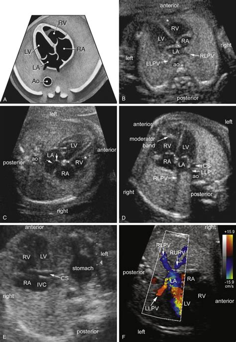 Sonographic Evaluation Of The Fetal Heart Radiology Key