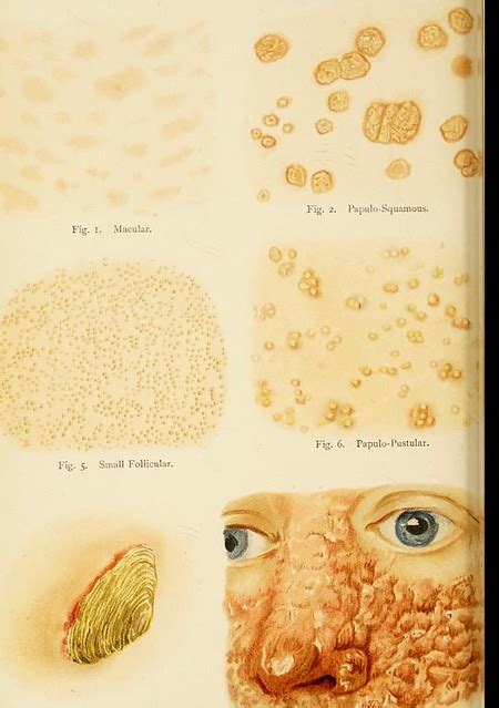 This Image Is Taken From Page 788 Of Diseases Of The Skin Flickr