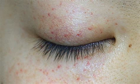 A Rash Localised Around The Eyes The Bmj