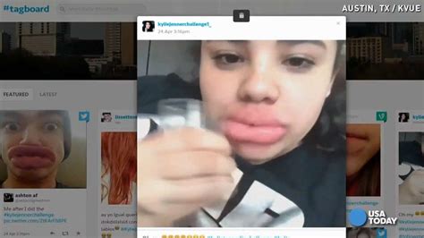 See Failings And Dangers Of Kylie Jenner Lip Challenge