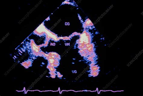 Coloured Ultrasound Scan Of A Normal Heart Stock Image P2160191
