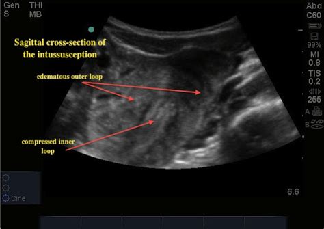 Intussusception Ultrasound Cases Info