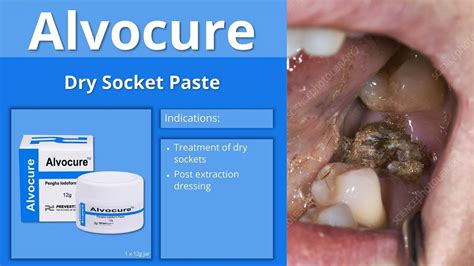 Alvocure Is A Dry Socket Treatment And Post Extraction Dressing Youtube