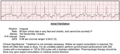 Atrial Fibrillation Ecg Acls Wiki