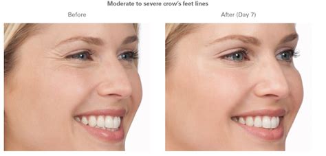 Botox® Face Lift Learn Which Cosmetic Treatment Is Right For You
