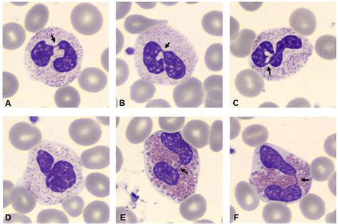 Frontiers Dysplasia Of Granulocytes In A Patient With Hpv Disease