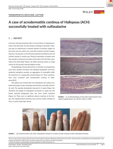 Pdf A Case Of Acrodermatitis Continua Of Hallopeau Ach Successfully