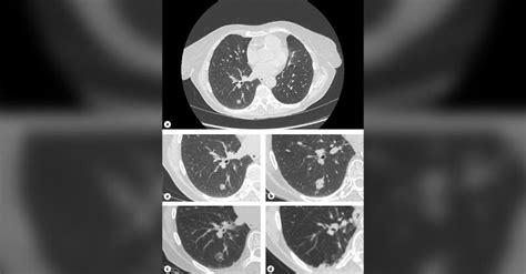 Squamous Cell Lung Cancer Patient Had Spontaneous Regression Medsynapse