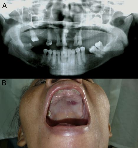Mucoepidermoid Carcinoma Floor Of Mouth