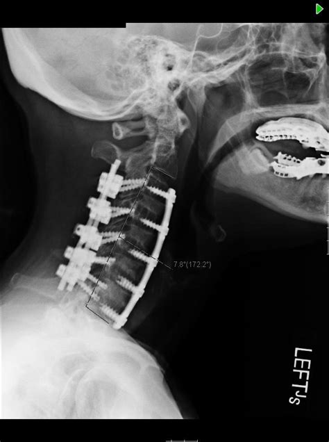 54 Yo Woman With Neuromuscular Condition And Cervical Scoliosis
