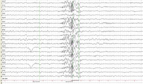 Juvenile Myoclonic Epilepsy Epilepsy Foundation