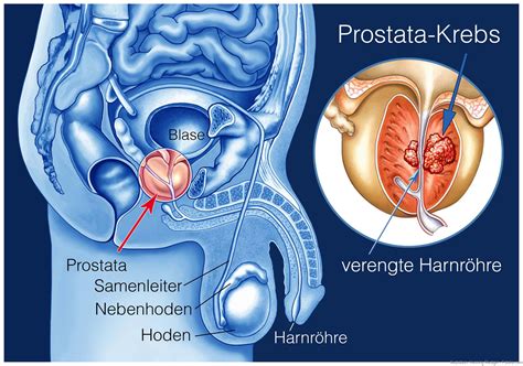 Gutartige Prostatavergrößerung: Neue Daten zu drei Laser ...