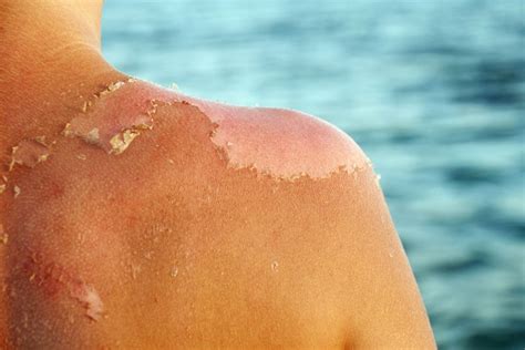 Formas De Prevenir O Descamação Da Pele Após Queimaduras Solares Exenin