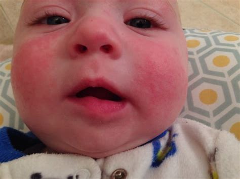 Rash Caused By Drool And The Cold Pic Babycenter