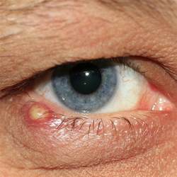 How To Treat A Stye Naturally And Medically Drugsbank