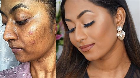How To Cover Acne Prone Skin And Hyperpigmentation Flawless Full