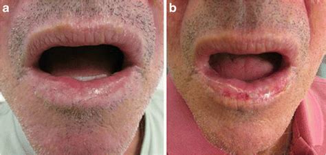 Grade Iv Actinic Cheilitis In The Lower Lip A Showing Worsening Of