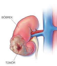 B Brek Kanseri Belirtileri Ve Risk Fakt Rleri Prof Dr Tibet Erdo Ru
