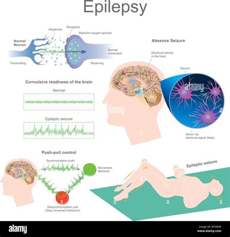 Epilepsy Mechanism