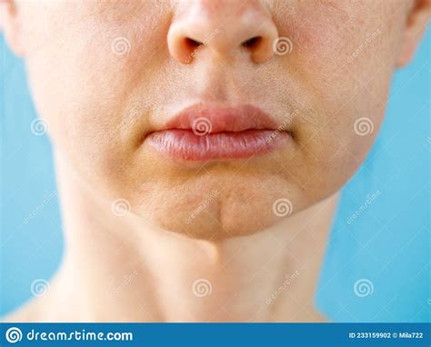 Teeth Problem Gumboil Flux And Swelling Of The Cheek With Bruise Royalty Free Stock Image