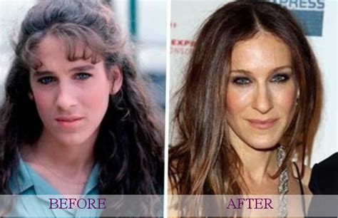 Celebrity Plastic Surgery Before And After