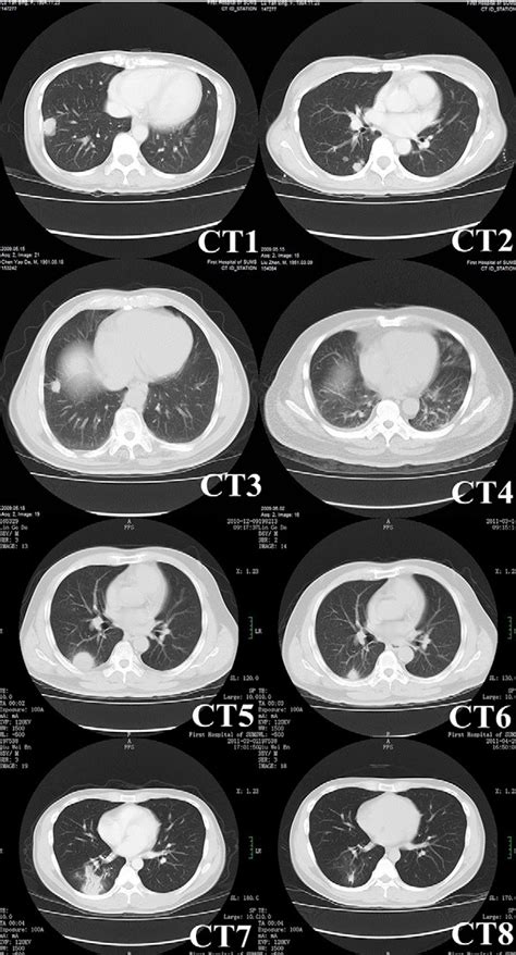 Figure 1 From Pulmonary Cryptococcosis In Non Aids Patients Semantic