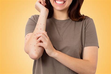 Scabies Causes Symptoms And Treatments Be Beautiful India