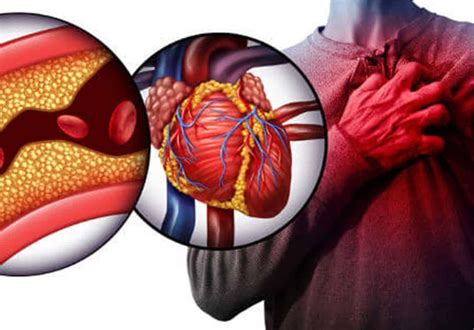 sintoma de infarto quais são como detectar e possíveis tratamentos