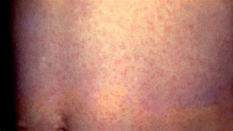 Measles Symptoms Diagnosis And Treatments
