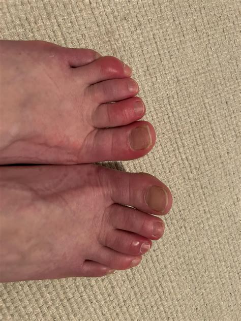 Swollen Itchy Red Toes Accurate Chilblains Anyone Else Have A