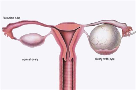ovarian cysts the pelvic clinic