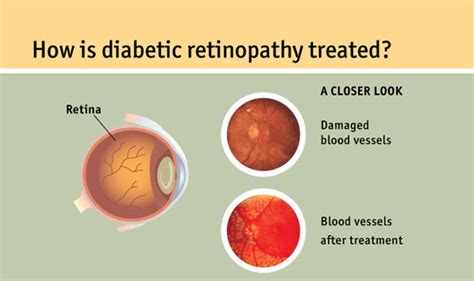 Diabetic Retinopathy Causes Symptoms Treatment Low Vision Aids