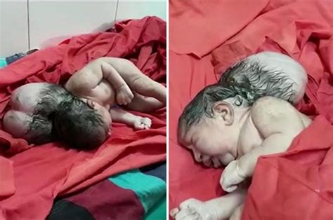 Indian Woman Gives Birth To Three Headed Baby Leaving Doctors In Shock