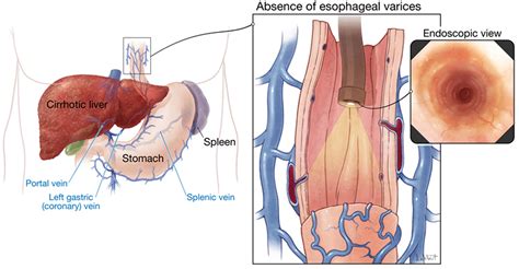 Esophageal Varices Causes Symptoms Grading Diagnosis Treatment