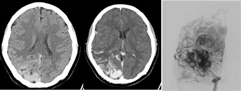Cerebral Arteriovenous Malformations Radiology Cases