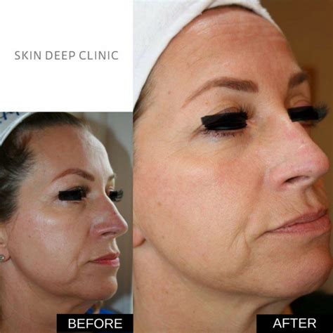 Profhilo Before And After Side View Skin Deep Clinic