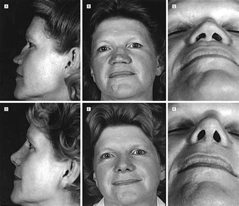 Three Step Reconstruction Of Complex Saddle Nose Deformities
