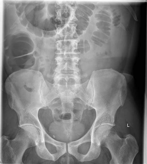The Xray Doctor Abdominal Distension Do The Xrays Tell You Why