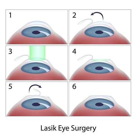 Laser Refractive Surgery Lasik Lasek Prk And Ptk Discovery Eye