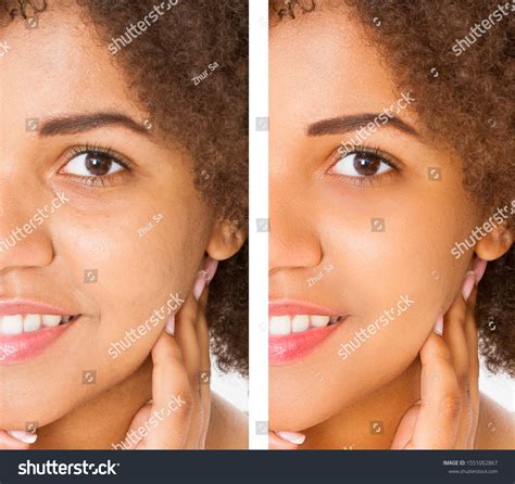 Acne Treatment For African American Skin Dermatology