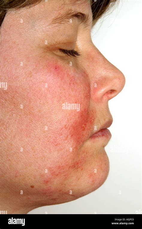 Shingles In The Face Stock Photo Alamy