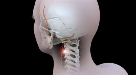 Cervicogenic Headache And Chiropractic Tri County Pain Management Centers