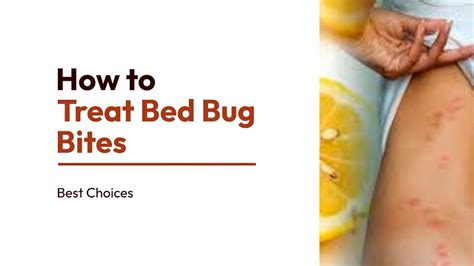 12 Easy Steps To Treat Bed Bug Bites How To Treat Bed Bug Bites