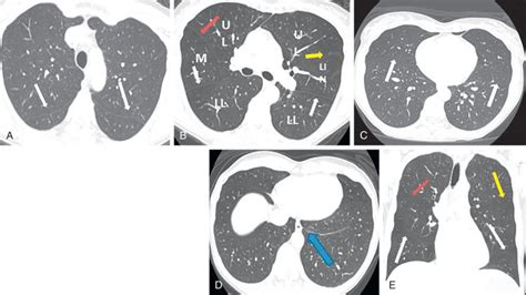 Normal Anatomy Of The Lungs Radiology Key