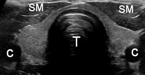 Ultrasound Of The Normal Thyroid With Technical Pearls And Pitfalls