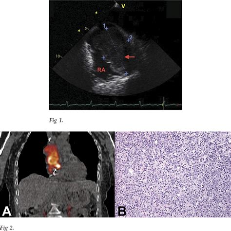 Figure 2 From Primary Cardiac Extranodal B Cell Lymphoma Mimicking