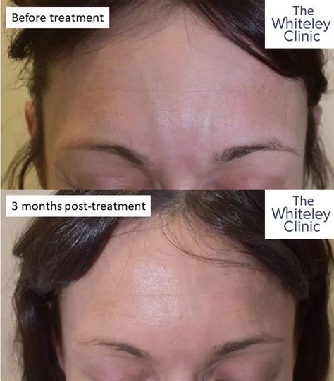 Facial Vein Conditions The Whiteley Clinic