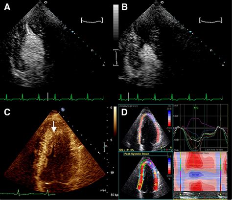 Echocardiography In Hypertrophic Cardiomyopathy The Role Of