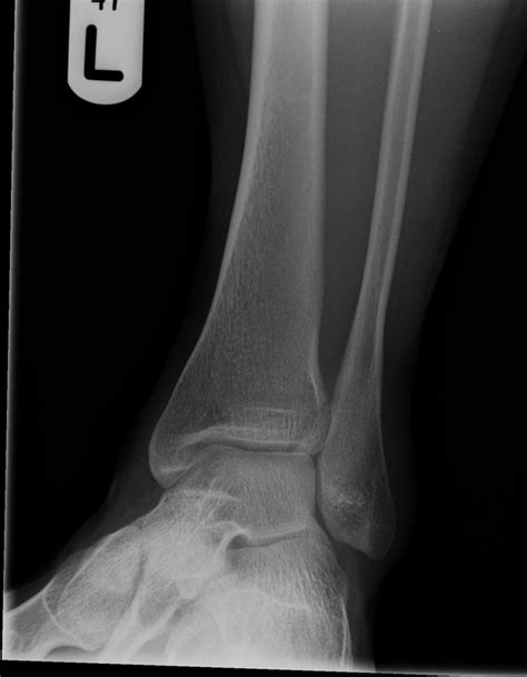 The Adult Tillaux Fracture One Not To Miss Bmj Case Reports